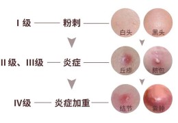 [为什么脸上抹东西疼呢]为什么你的脸上经常长痘？这篇必看！