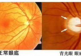 [青光眼与干活有关吗]五官专家